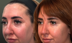 before and after of nose filler